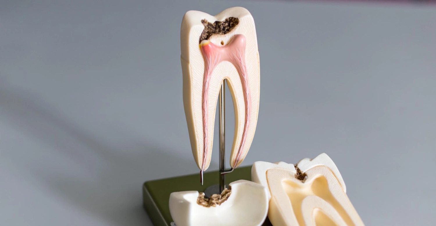 is a root canal orthodontics Inblog